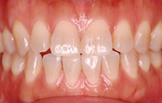 Case.4 歯茎の着色がきになるのと歯を白くしたい場合