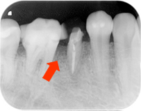 Case.3 歯周病により歯茎が腫れて骨が溶けてしまっている場合