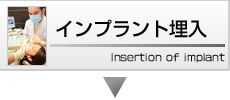 インプラント埋入